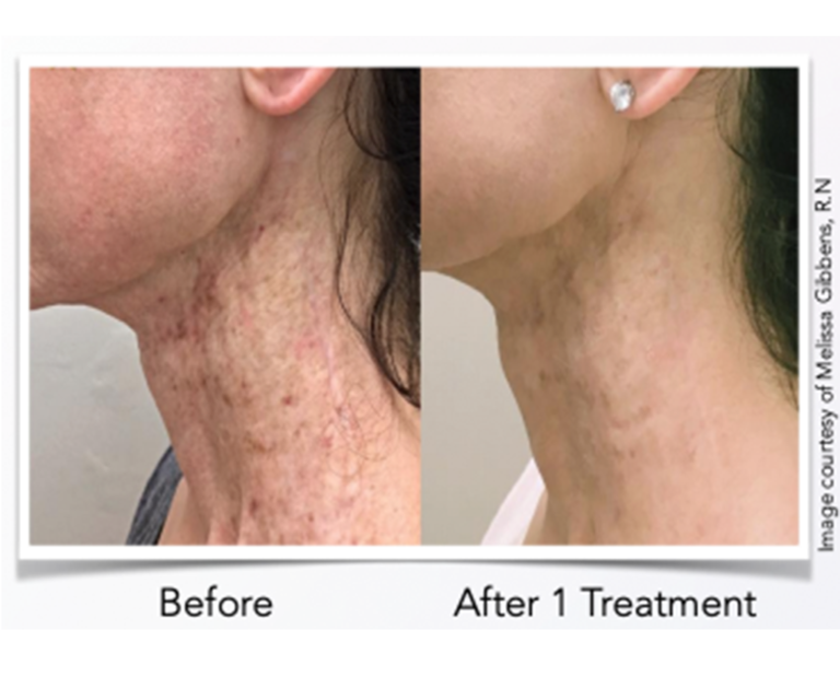 NeoGen PSR Machine Cincinnati NeoGen Plasma Skin Regeneration